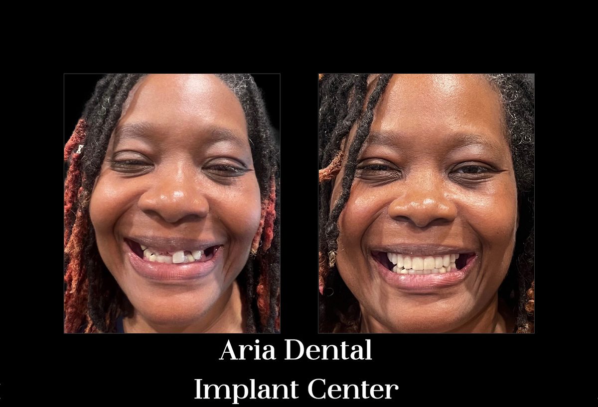 Before and after smile transformation of a real Aria Dental Implant Center patient