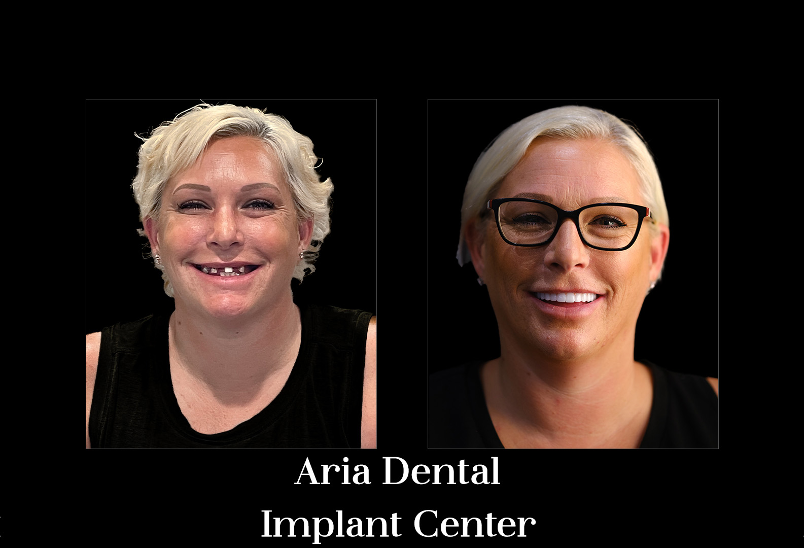 Before and after smile transformation of a real Aria Dental Implant Center patient
