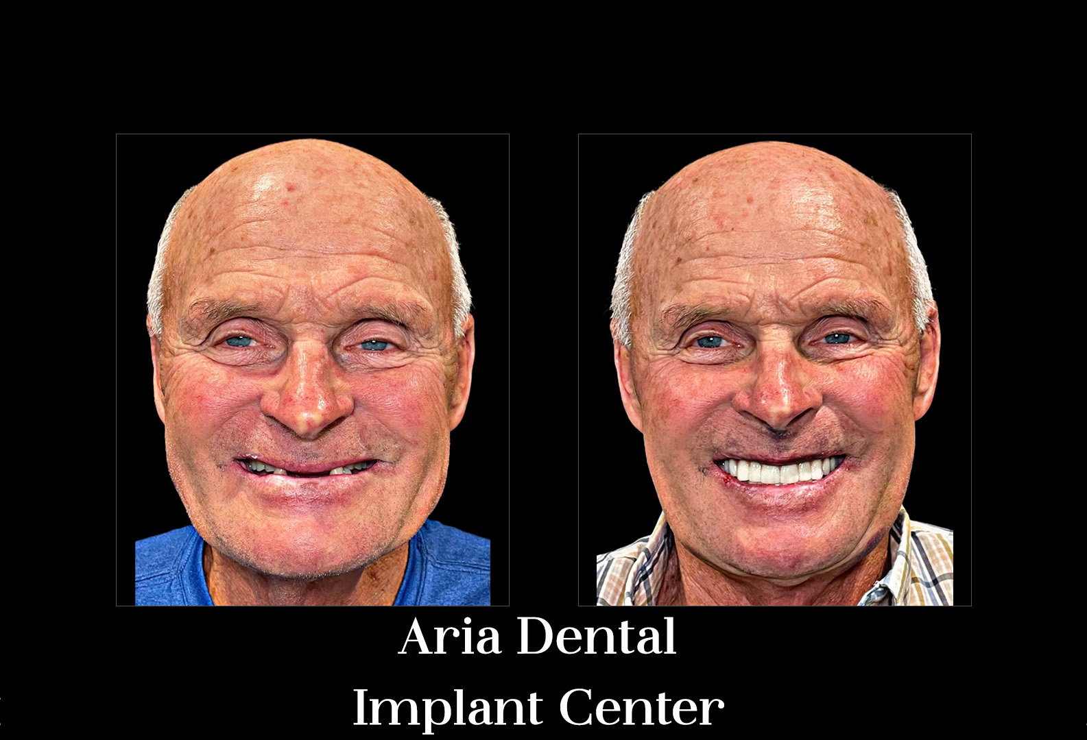 Before and after smile transformation — Aria Dental Implant Center patient