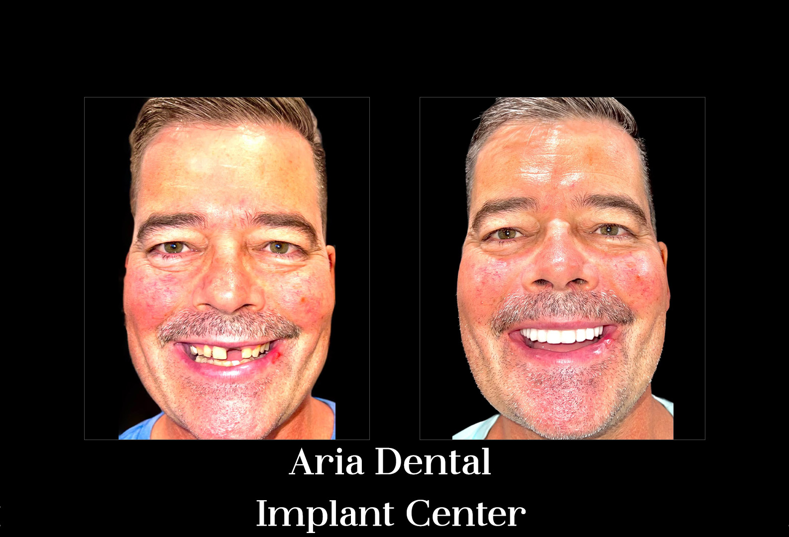 Before and after smile transformation — Aria Dental Implant Center patient