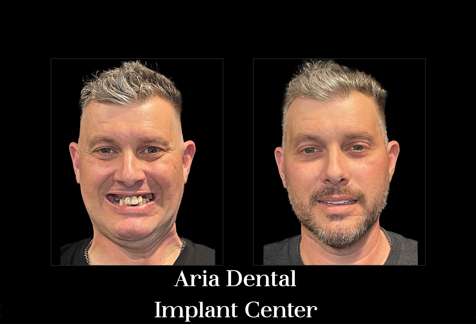 Before and after — Aria Dental Implant Center patient