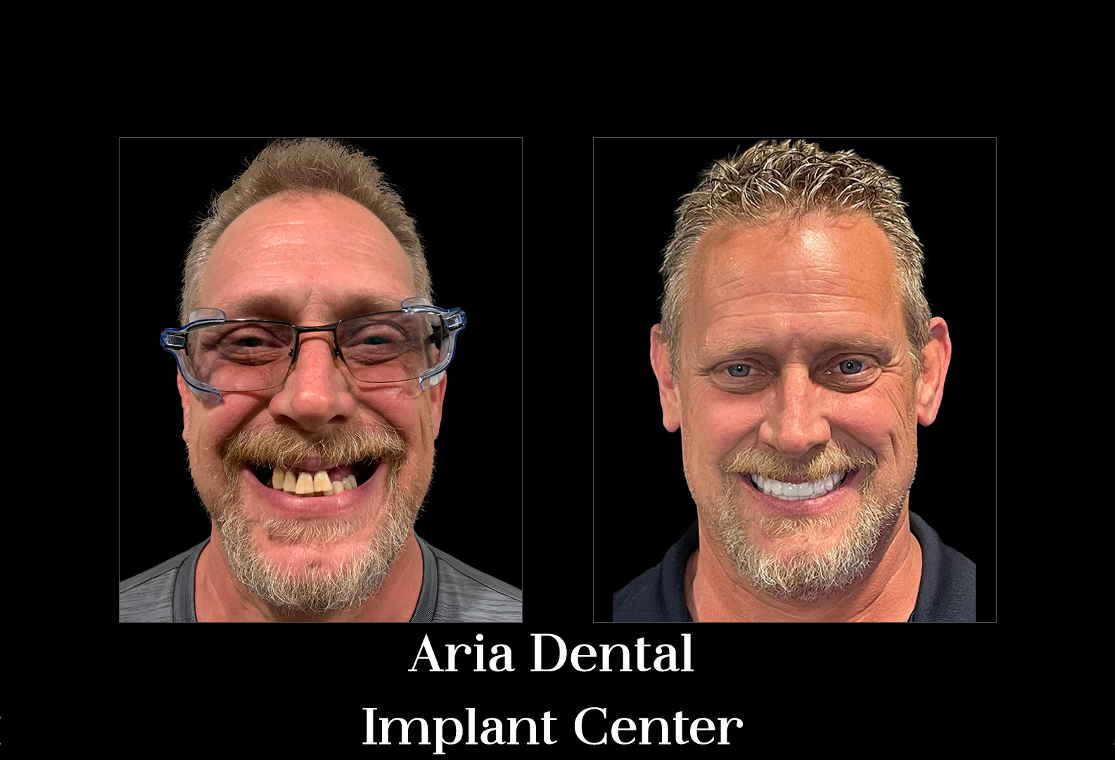 Before and after — Aria Dental Implant Center patient