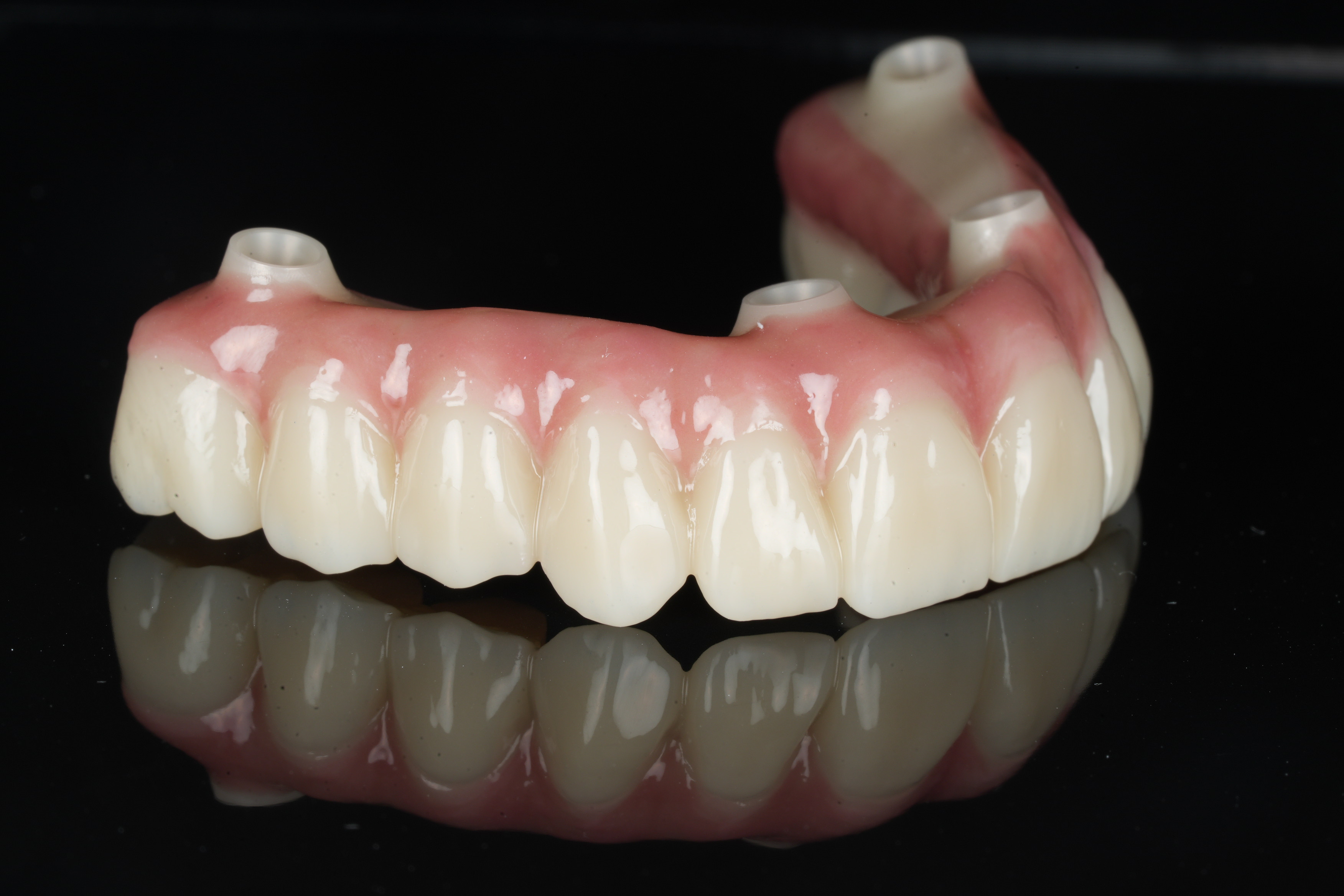 NobelProcera zirconia implant bridge in a natural shade — angled view, Aria Dental Implant Center