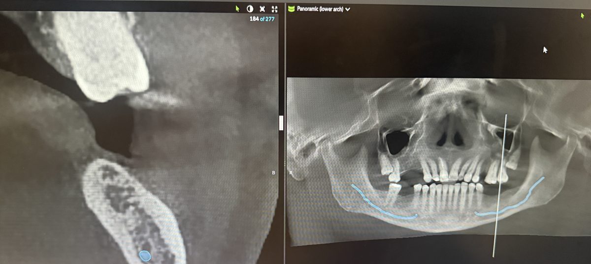 3D CBCT scan used for dental implant planning at Aria Dental Implant Center in Phoenix